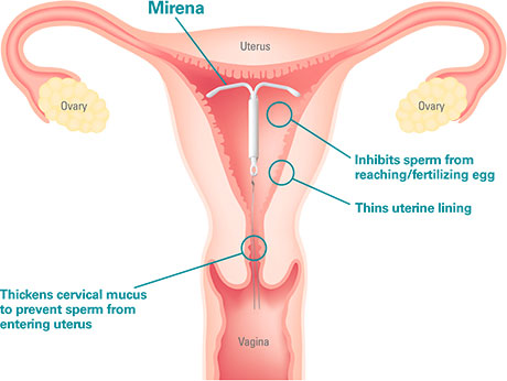mirena IUD birth control
