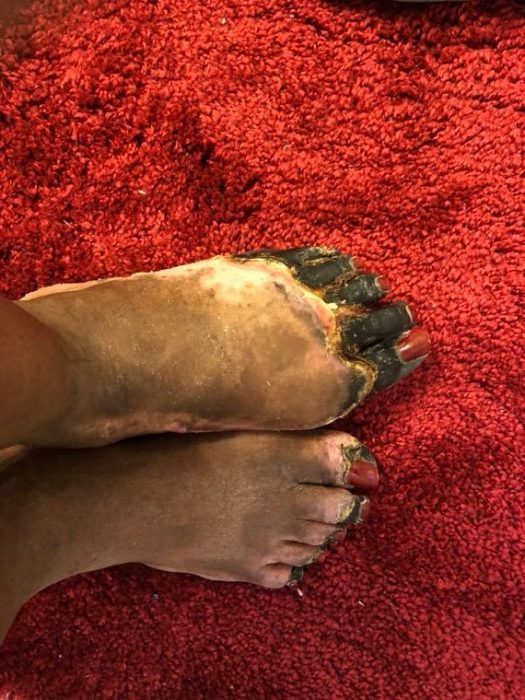 Tanai Smith lost the toes on one foot and the tips of her toes on the other after surgery to remove an IUD that had migrated.