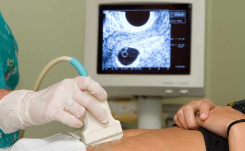 Doctors said she miscarried and was at risk. Another ultrasound ‘found a tiny heartbeat.’