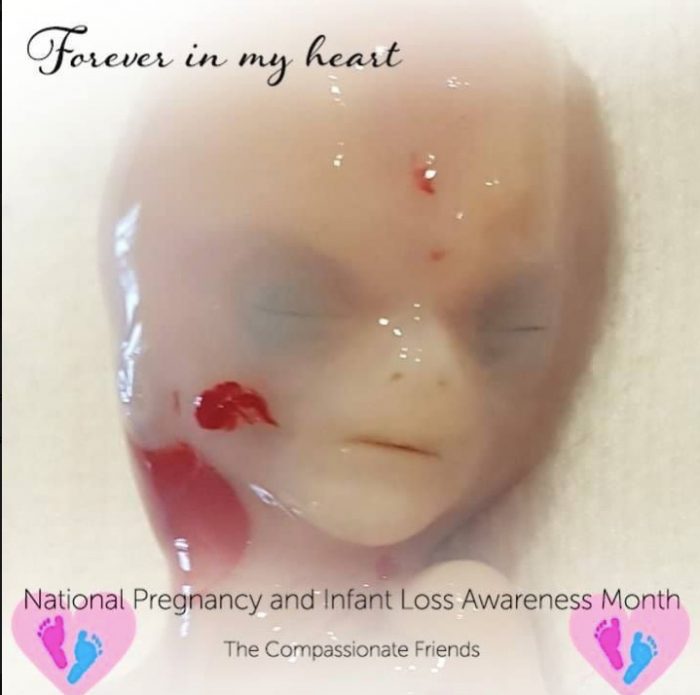 miscarried, miscarriage, 14 weeks