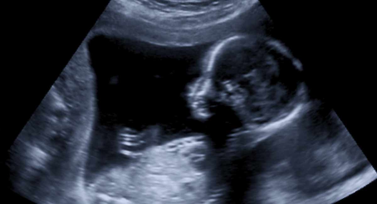 abortion, disability, ultrasound, third trimester