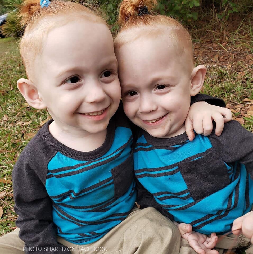 conjoined twins