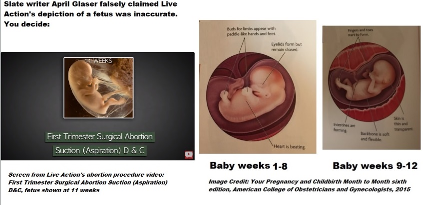 Image: Live Action aspiration abortion procedures video first trimester fetal image V ACOG
