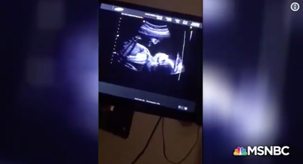 pregnancy, ultrasound