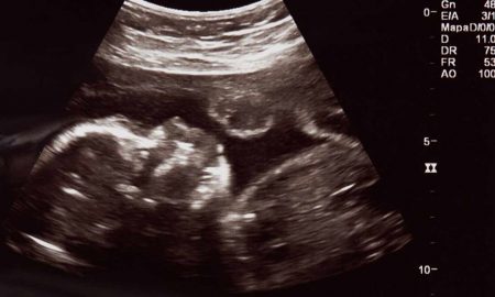 heartbeat bill, pro-life