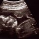 heartbeat bill, pro-life