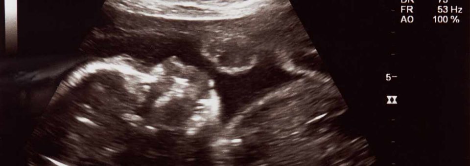 heartbeat bill, pro-life