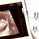 abortion, pregnancy, Louisiana, ultrasound, heartbeat