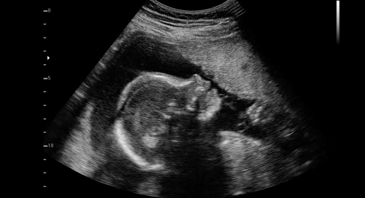 heartbeat, pro-life, ultrasound, pro-life