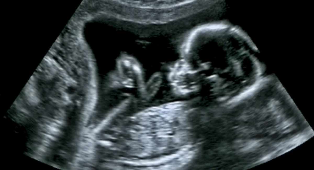 preborn babies, ultrasound, pregnancy centers, abortion, poll, diagnosis