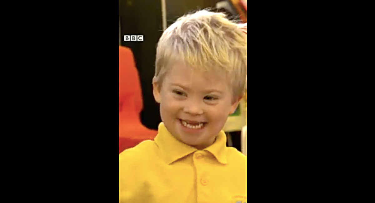 Down syndrome