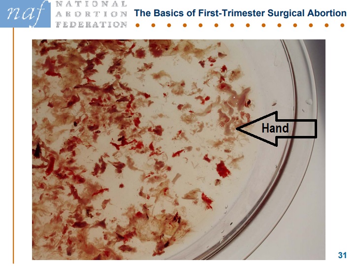 USF Articles only Image: NAF Slide abortion at nine weeks