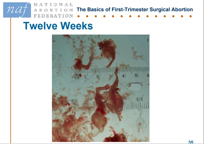 USF Articles only Image: NAF Slide abortion at twelve weeks