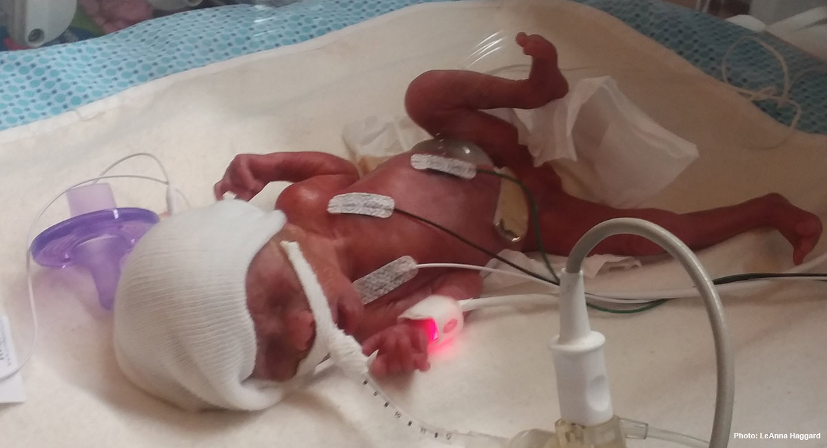 Miracle Born At 24 Weeks My Baby And I Survived A High Risk Pregnancy