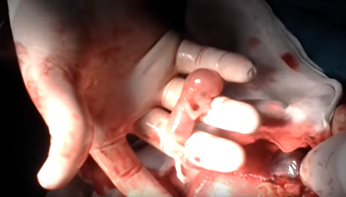 Image: Preborn baby ectopic pregnancy 10 weeks gestation