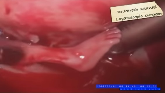 Image: Preborn baby ectopic pregnancy 14 weeks gestation fetal leg