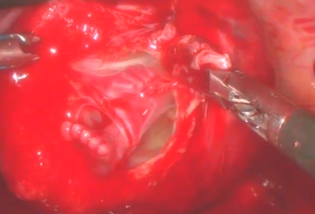 Image: Preborn baby foot ectopic pregnancy 13 weeks gestation