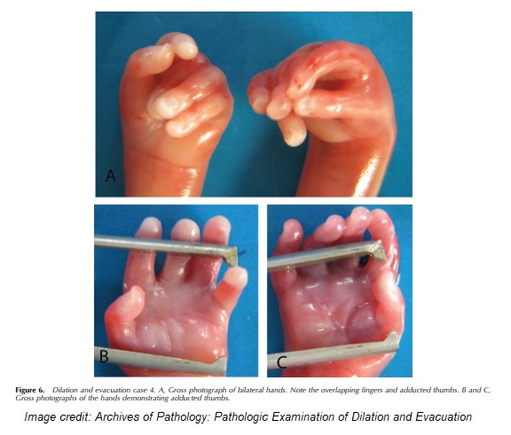 Image: Second trimester D+A abortion specimen fetal hands (Image credit: Archives of Pathology) 