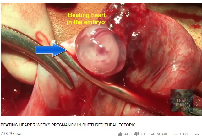 Image: Unborn child ectopic pregnancy 7 week gestation beating heart