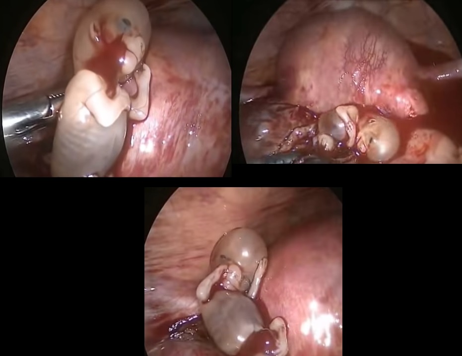 Image: Unborn child ectopic pregnancy unknown gestation 