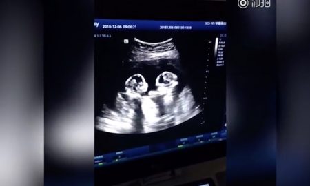 twins ultrasound