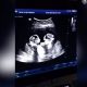 twins ultrasound