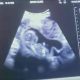 Unplanned abortion