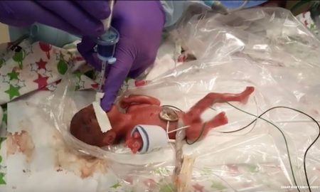 premature baby