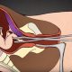 Arizona, Michigan, D&E, dismemberment, Texas