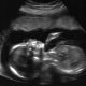 abortion, ultrasound, pregnancy