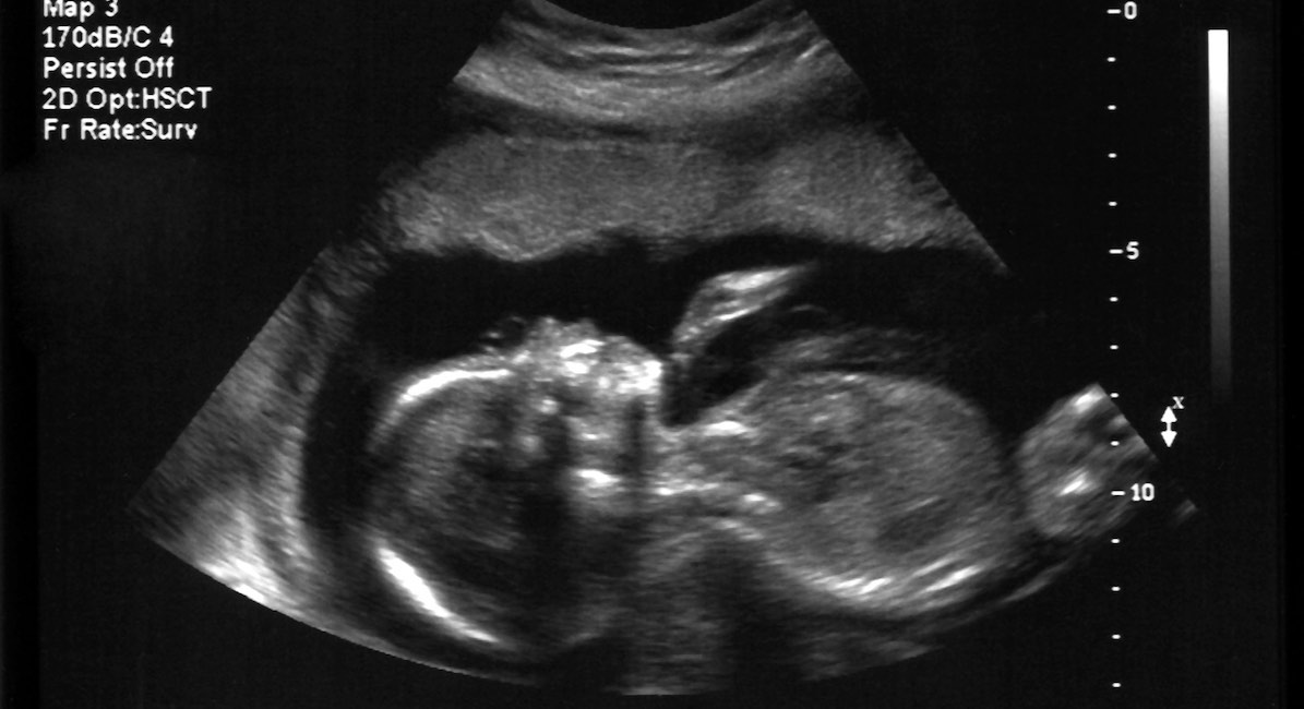 A ultra sound picture of a baby