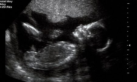 ultrasound, viability, abortion