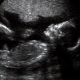 ultrasound, viability, abortion