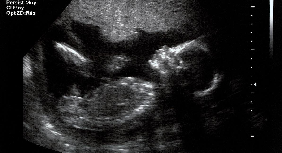 ultrasound, viability, abortion