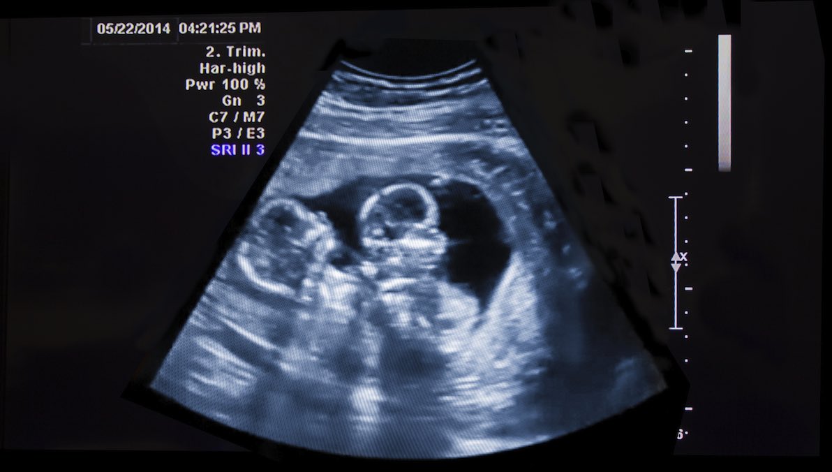 Twins Ultrasound