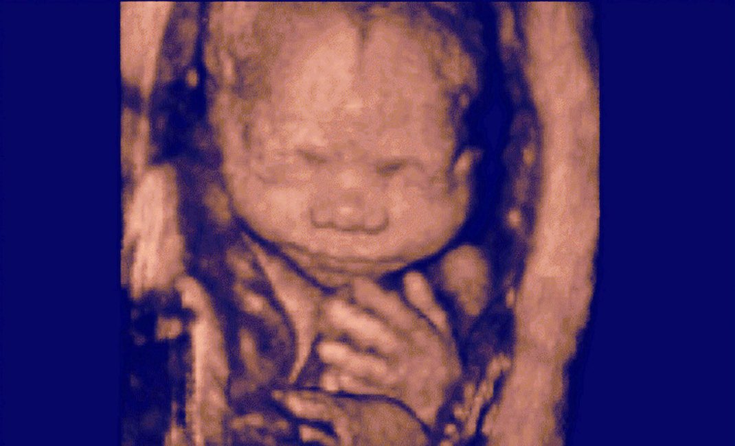Fetus, 3D Sonography