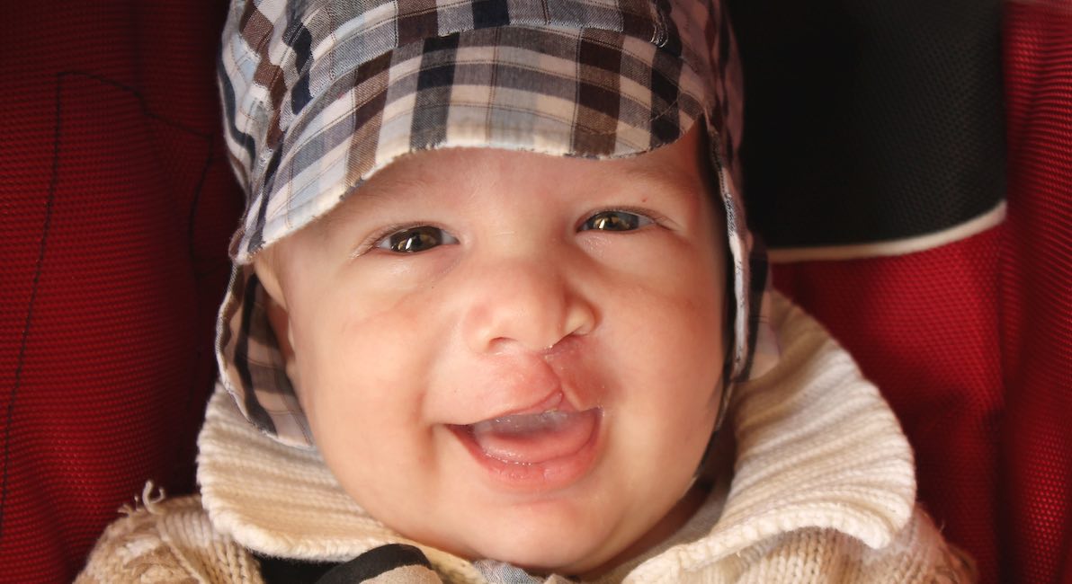 cleft lip