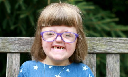 Sarah, craniofacial abnormalities, Apert syndrome