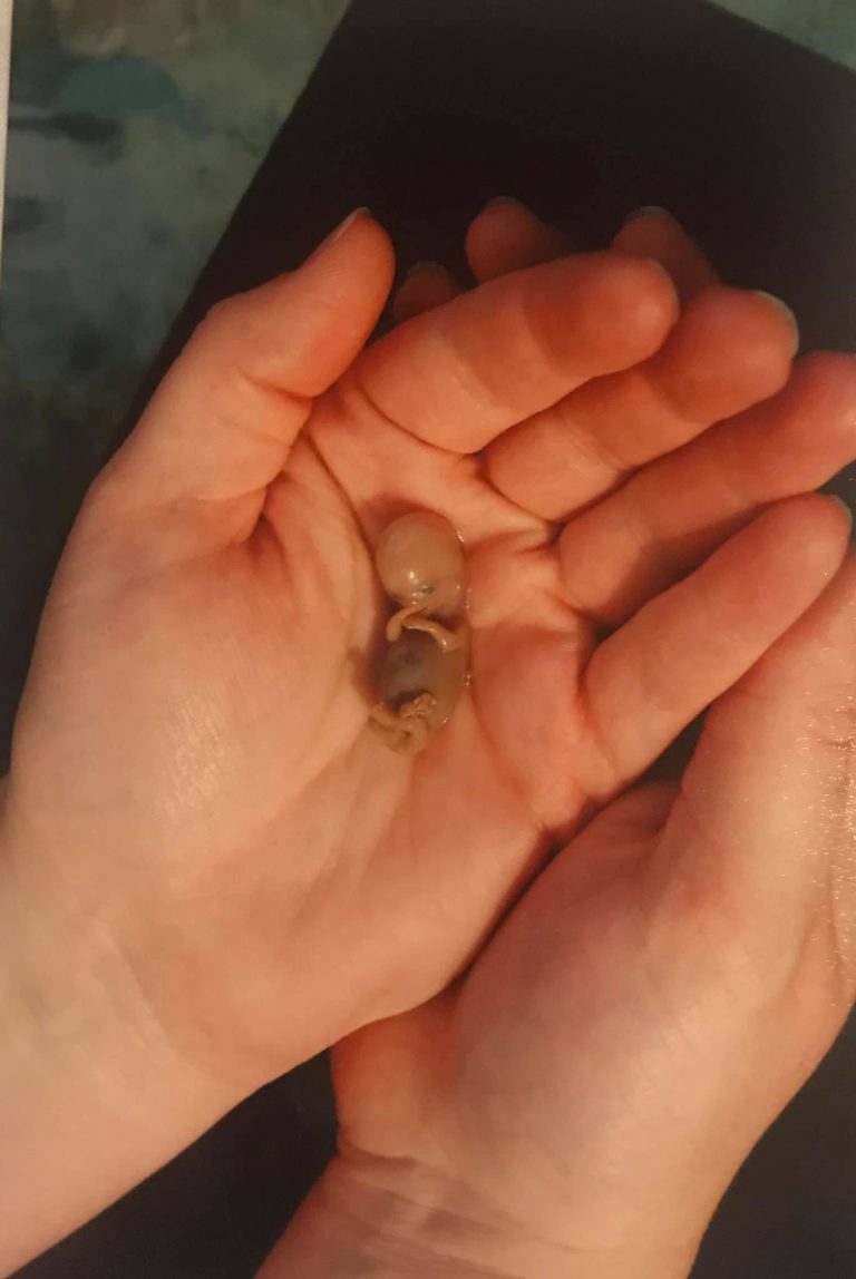 Woman Shares 10 week Miscarriage Photos To Show Humanity Of Baby miscarriage-babycentre