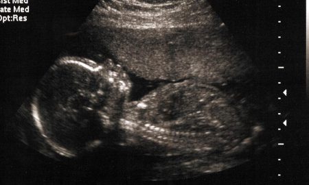 20 weeks, abortion, media