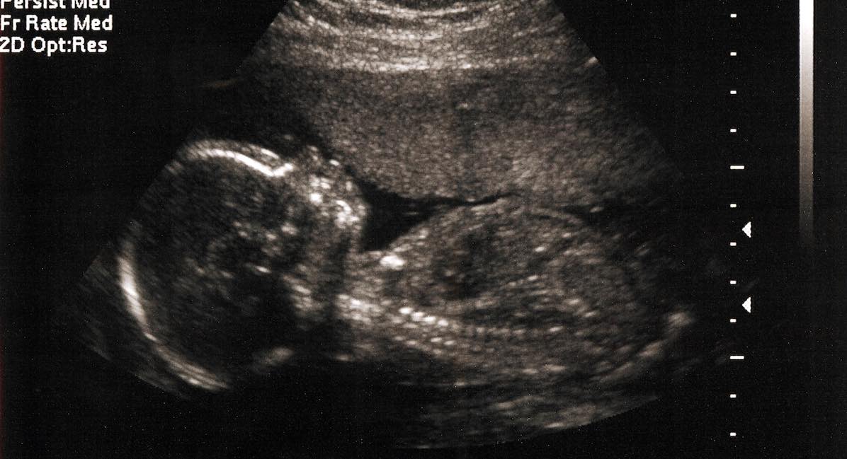 fetus ultrasound at 20 weeks
