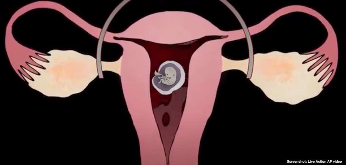 Live Action abortion pill