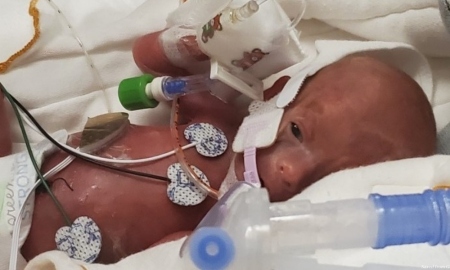 micro-preemie, premature