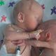 premature twins