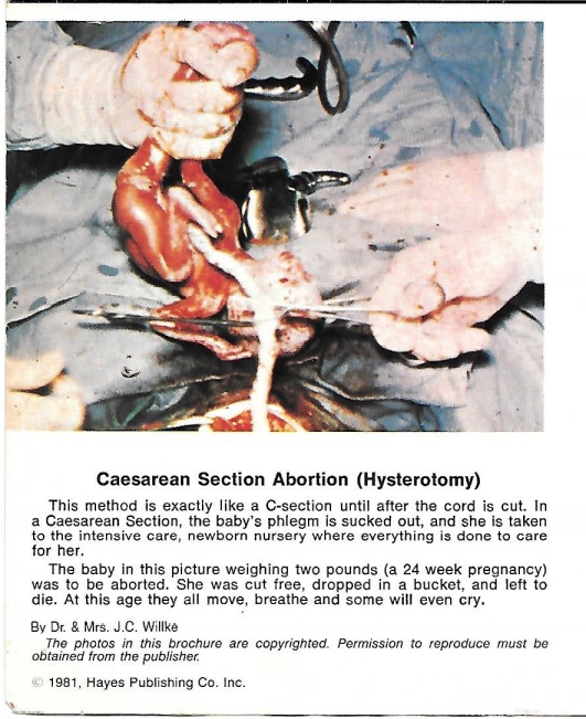Image: Hysterotomy abortion (Image: Death or Life Brochure by Hayes Publishing 1981)