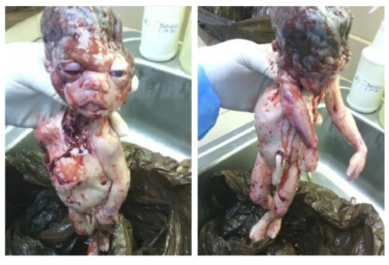 Images: Aborted baby images to Operation Rescue from staff at Houston abortion facility operated by Douglas Karpen