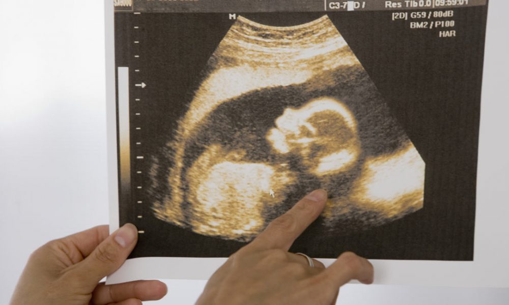 Gallup, Ireland, preborn, autism