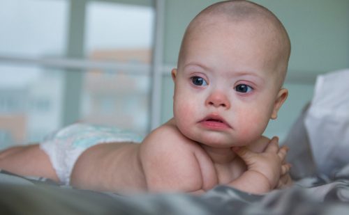 Researchers say they eliminated the extra chromosome in cells with Down syndrome