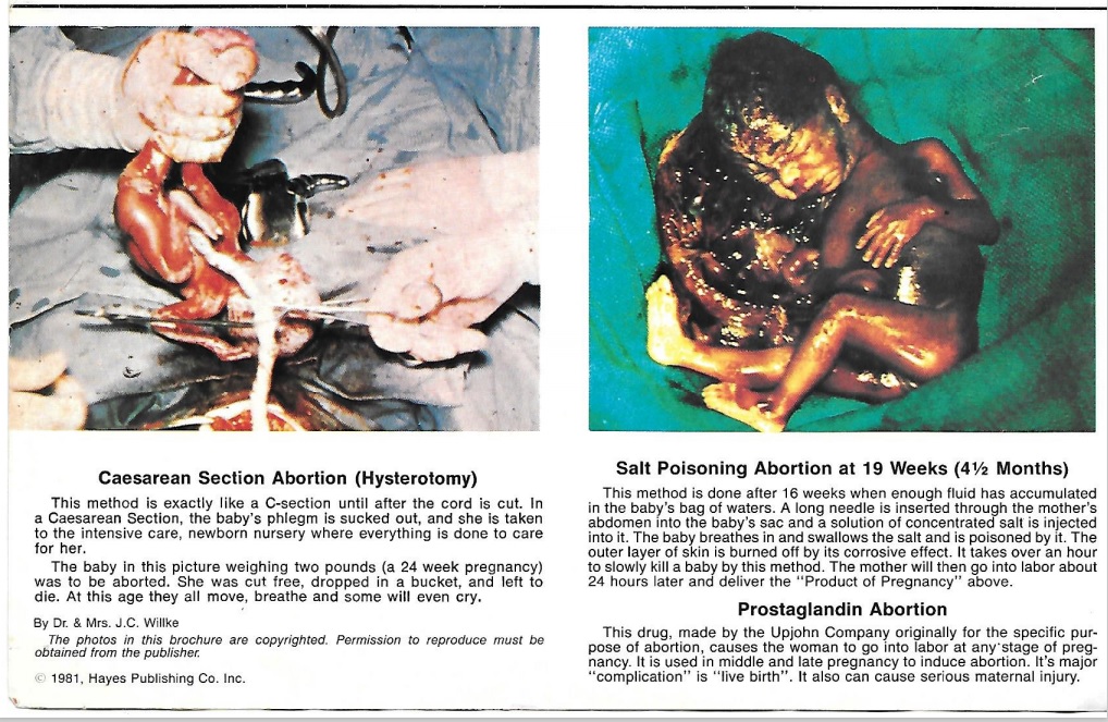 Image: Hysterotomy and Saline or Prostaglandin abortion procedures (Image: pamphlet Life or Death Hayes Publishing) 