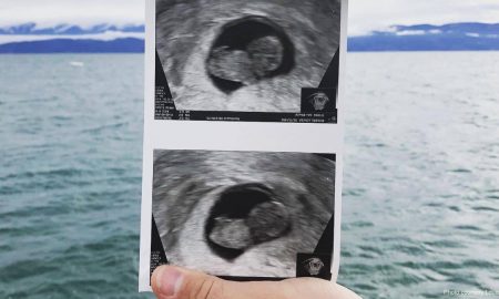 miscarriage, miscarried, ultrasound